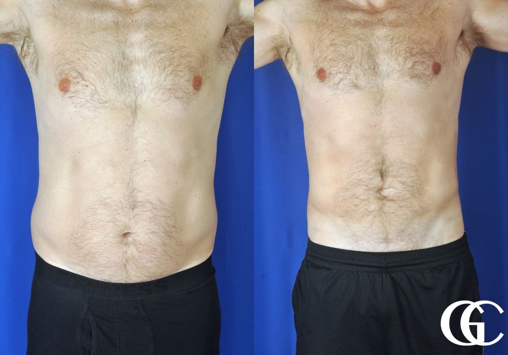 Liposuction - Thumbnail 2