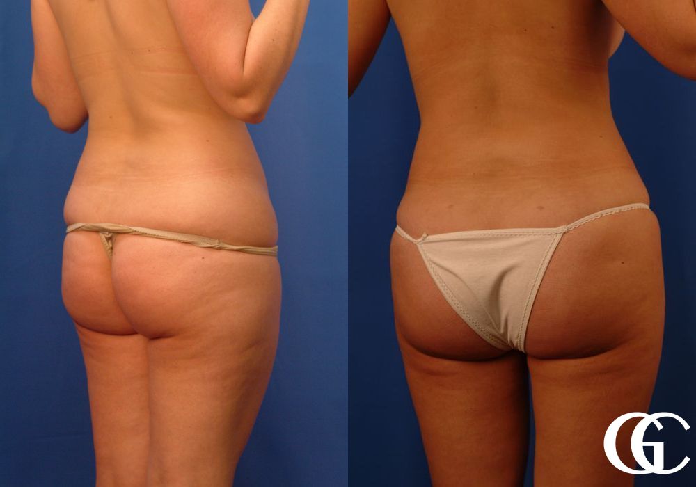 Liposuction - Thumbnail 3