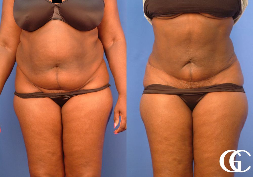 VASER® Lipo - Case 7028