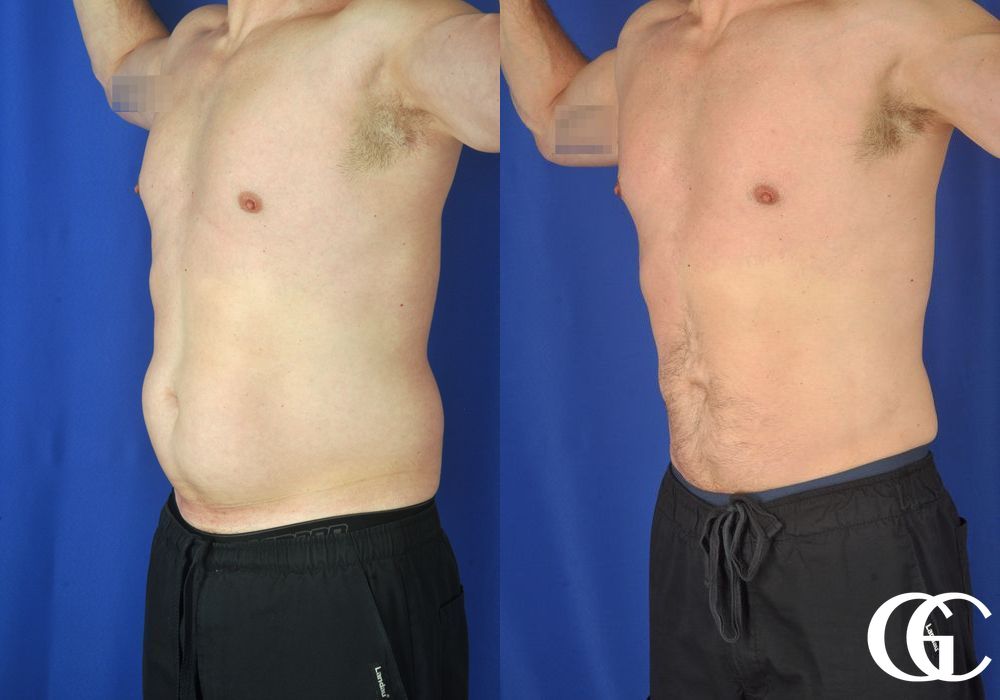 Liposuction - Case 6967