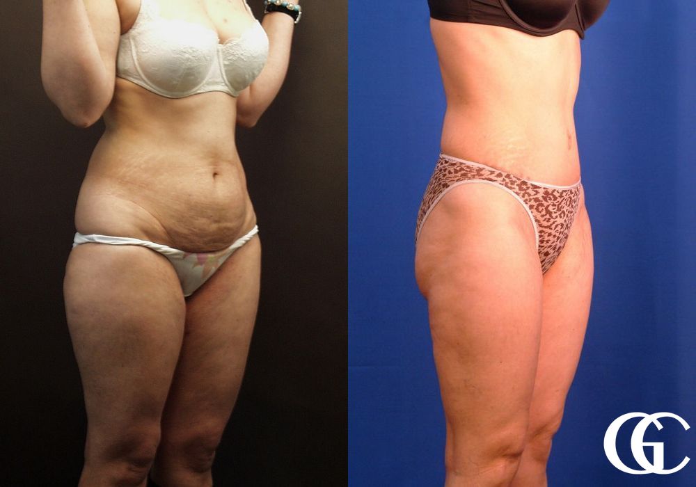 Liposuction - Thumbnail 2