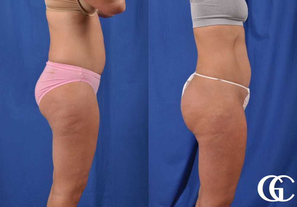 Liposuction - Case 6962