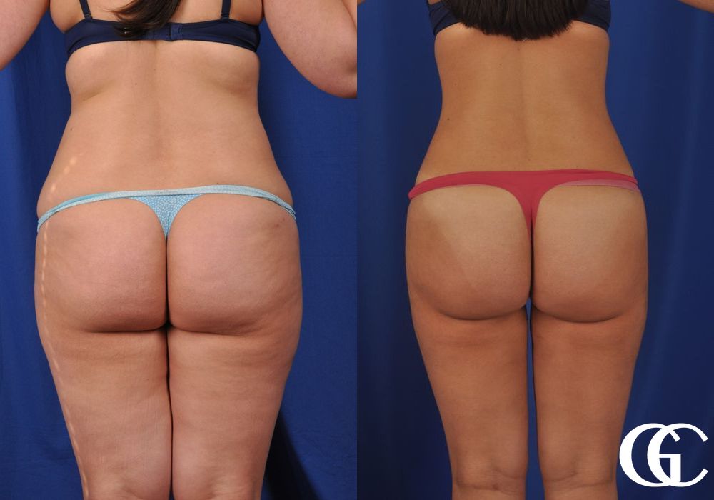 VASER® Lipo - Thumbnail 2