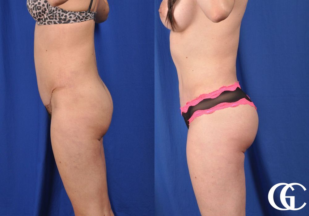 Liposuction - Thumbnail 2