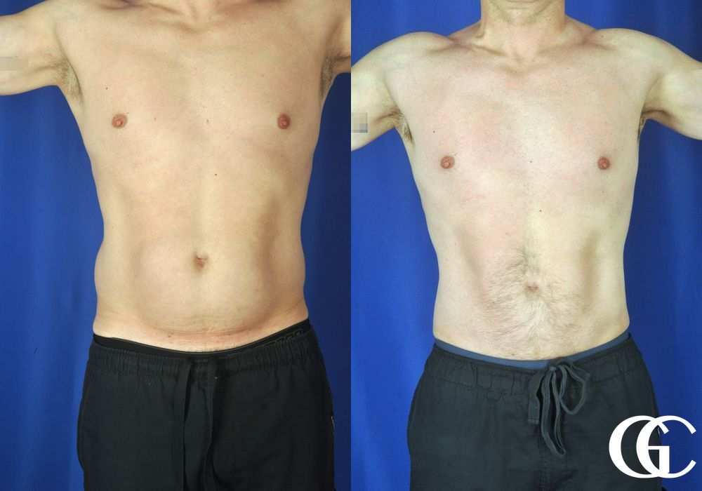 Liposuction - Thumbnail 2