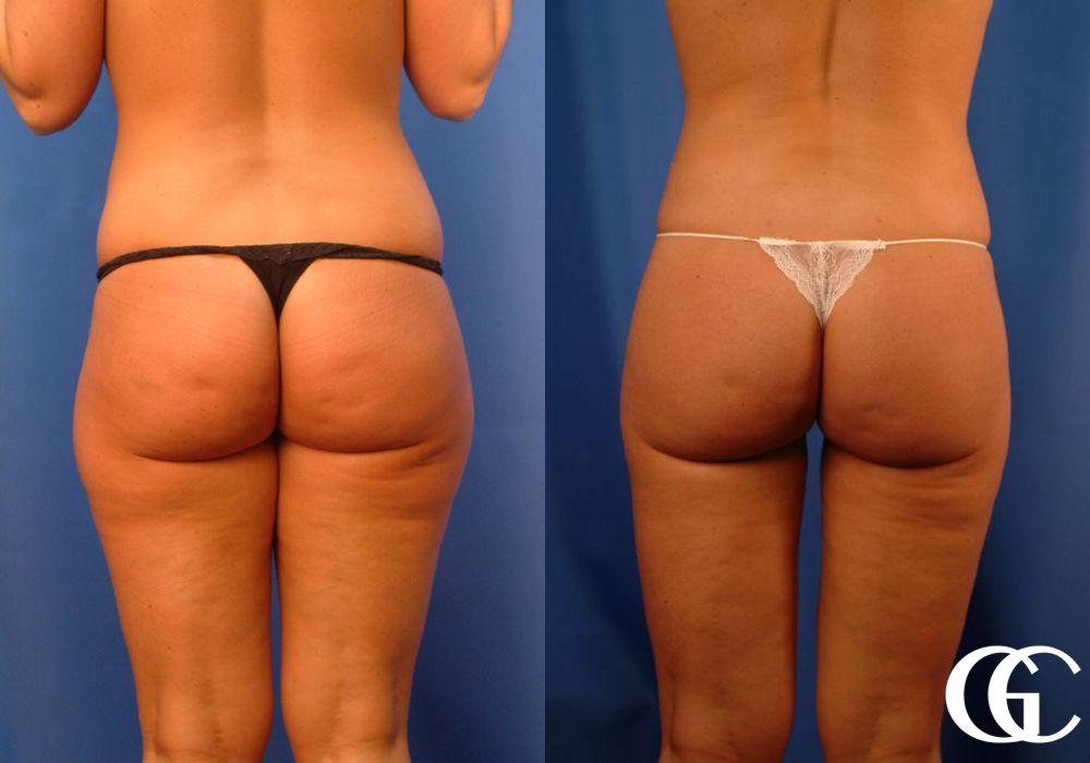 Liposuction - Case 6940