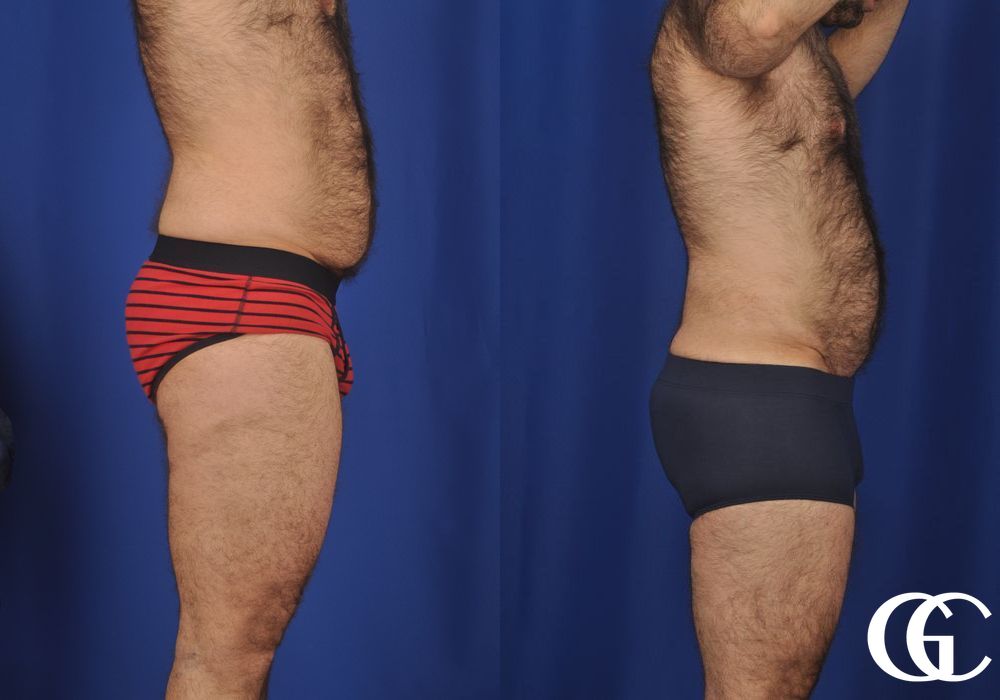 Liposuction - Thumbnail 3