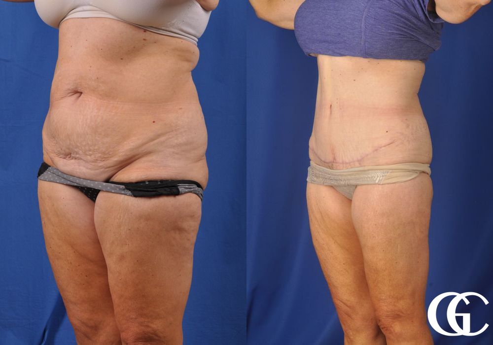 Liposuction - Thumbnail 5