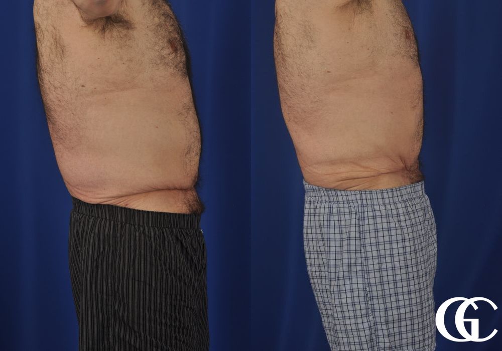 Liposuction - Thumbnail 4