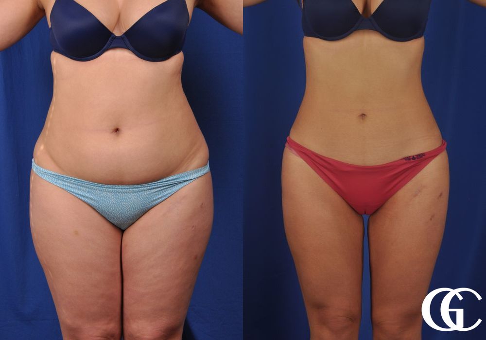 VASER® Lipo - Thumbnail 3