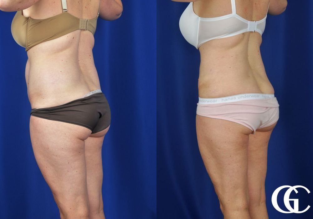 Liposuction - Case 6926