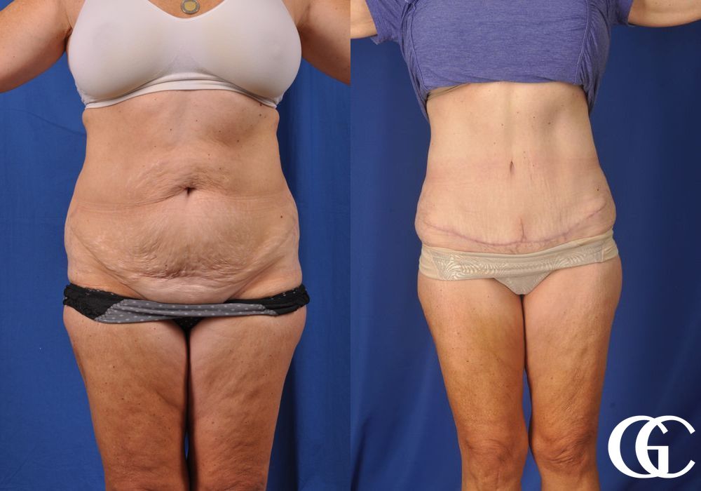 Liposuction - Thumbnail 2