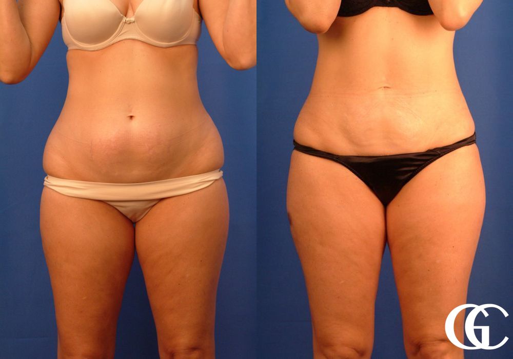 VASER® Lipo - Thumbnail 2