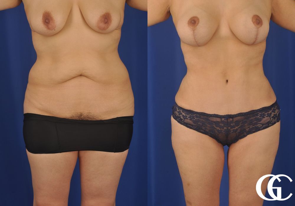 Tummy Tuck - Case 7010