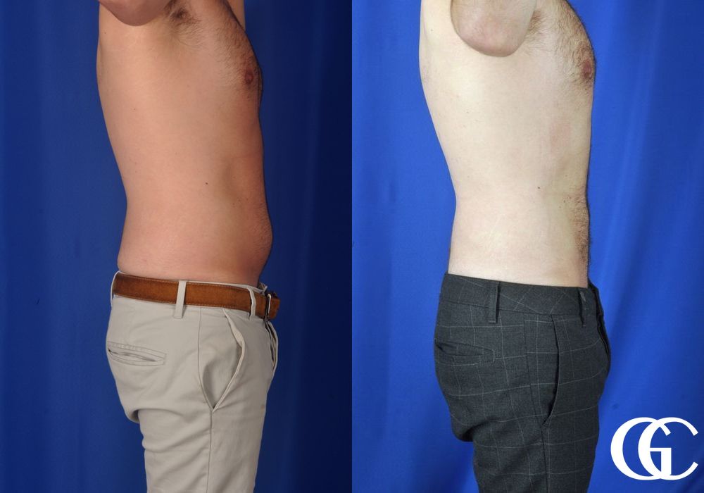 Liposuction - Thumbnail 3