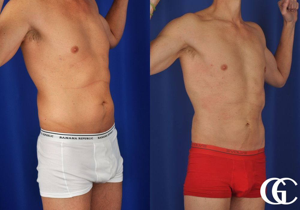 Liposuction - Thumbnail 2