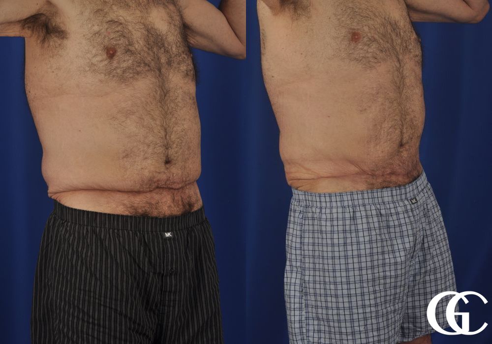 Liposuction - Thumbnail 3