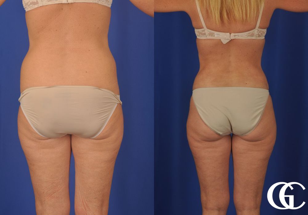 Lipoabdominoplasty - Thumbnail 4