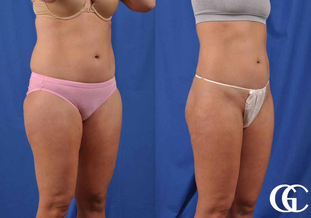 Liposuction - Thumbnail 3