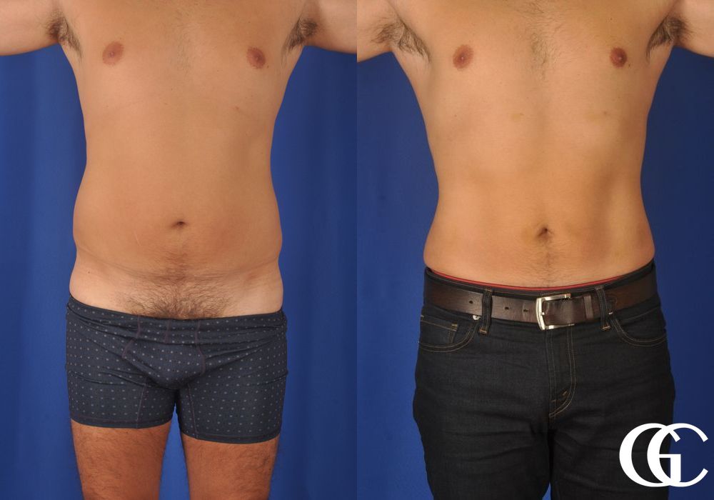 Liposuction - Thumbnail 3