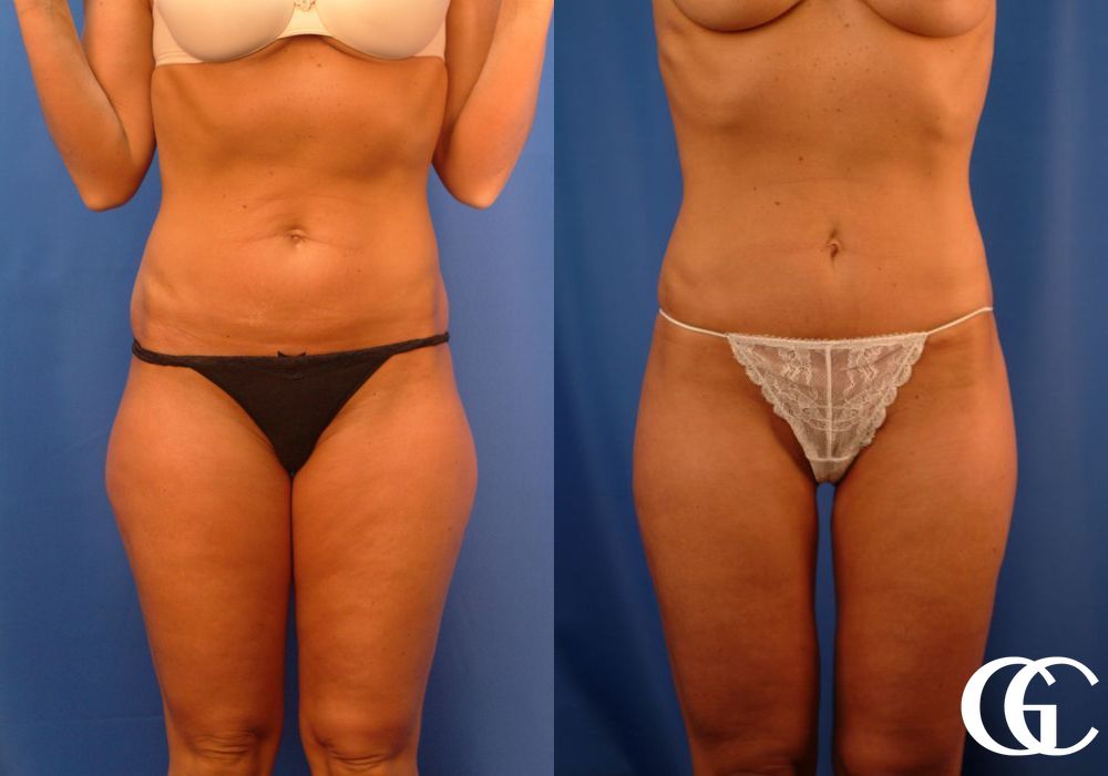 Liposuction - Thumbnail 2