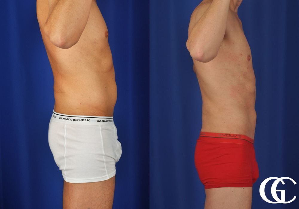 Liposuction - Thumbnail 3