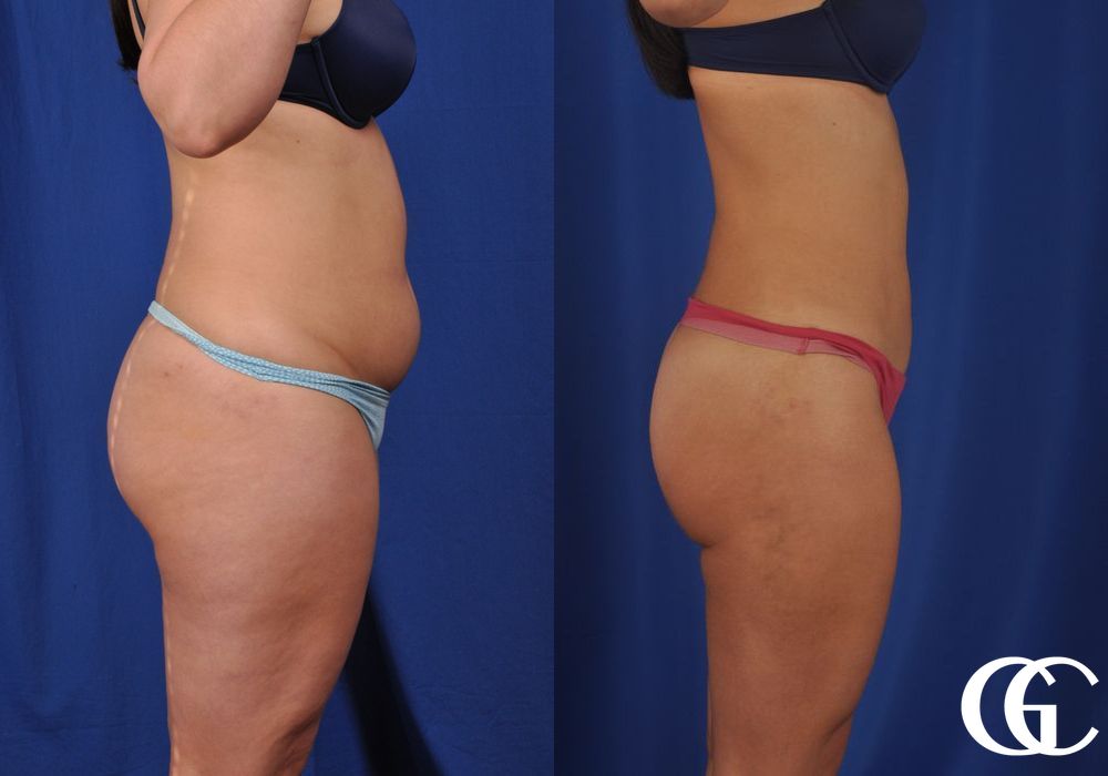 VASER® Lipo - Thumbnail 4