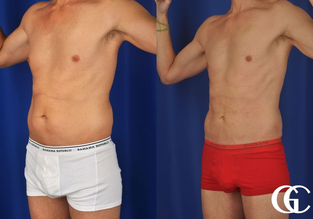 Liposuction - Thumbnail 5