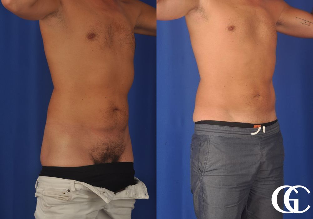 Liposuction - Case 6976