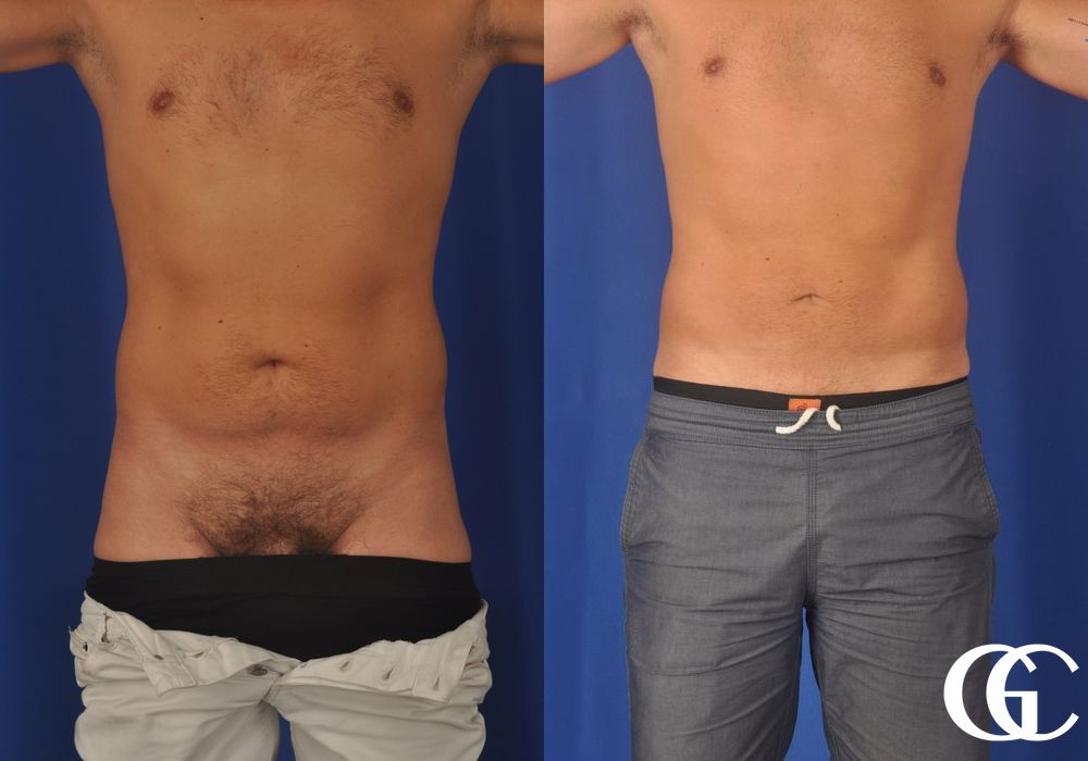 Liposuction - Thumbnail 2