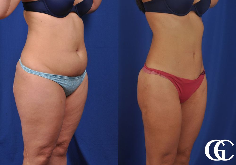 VASER® Lipo - Case 7031