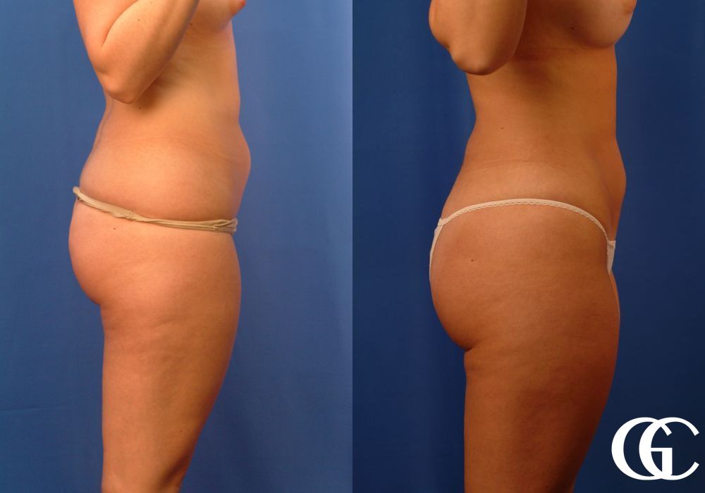 Liposuction - Thumbnail 2