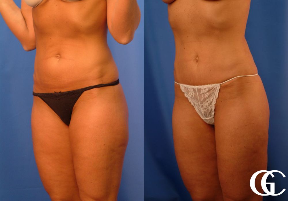 Liposuction - Thumbnail 5