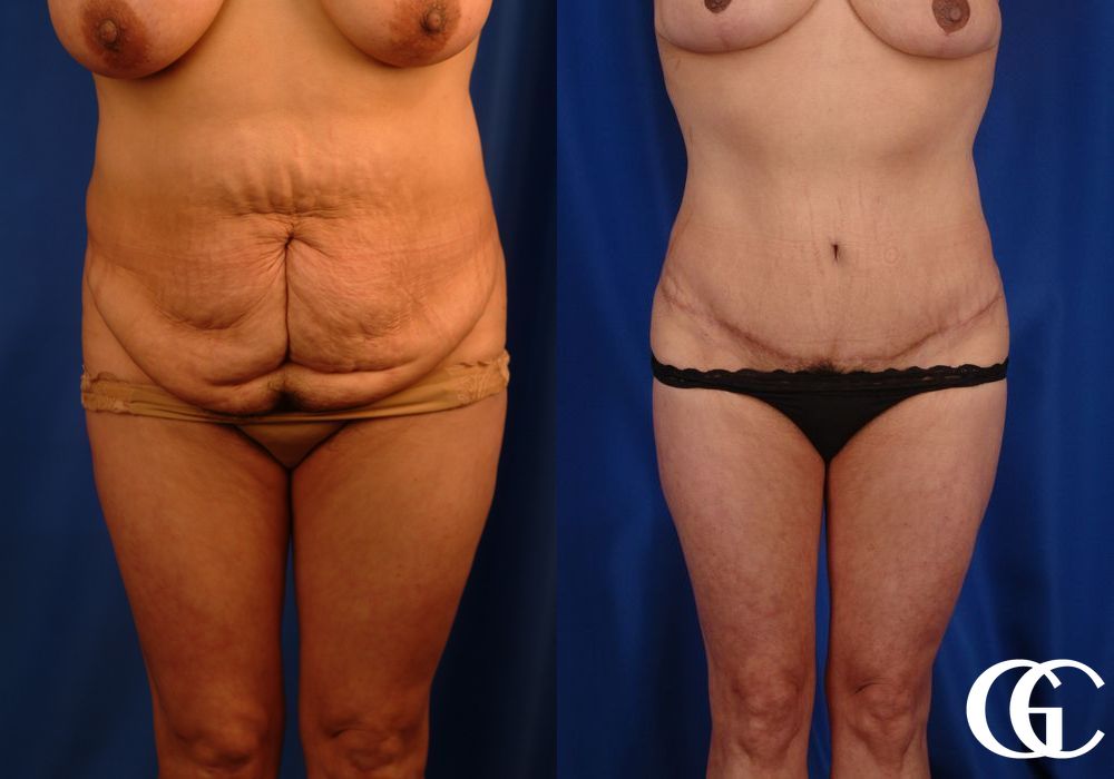 VASER® Lipo - Case 7030