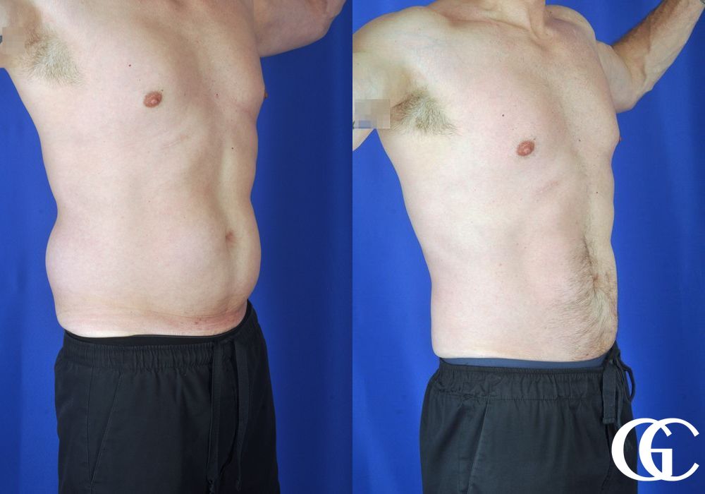 Liposuction - Thumbnail 3