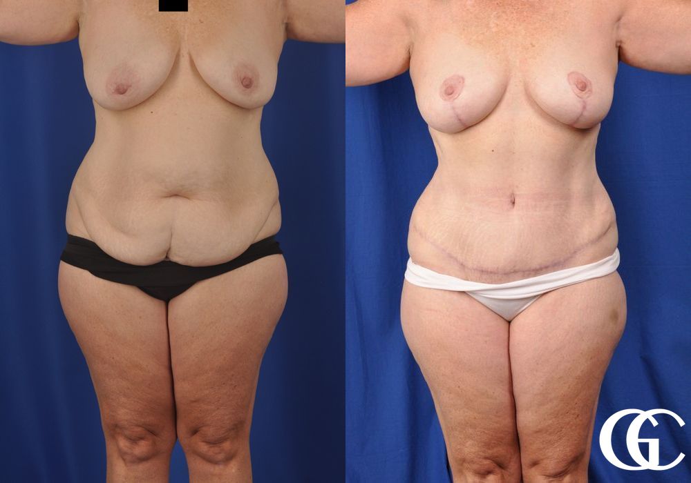 Tummy Tuck - Case 7004