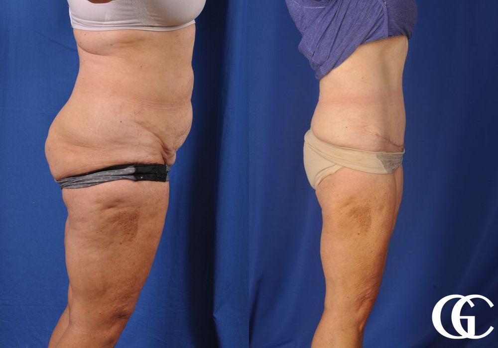 Liposuction - Case 6955