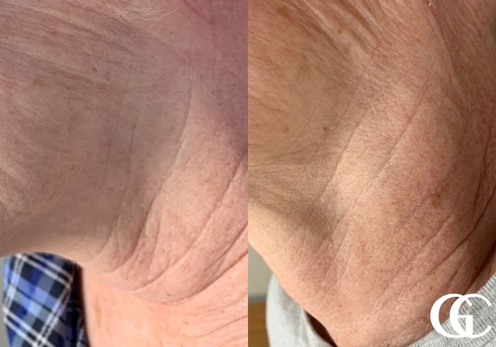 SkinPen® - Case 7464