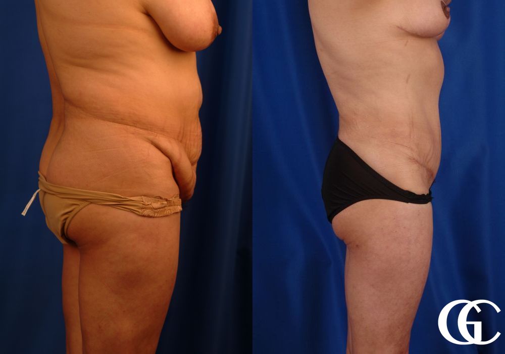 VASER® Lipo - Thumbnail 2