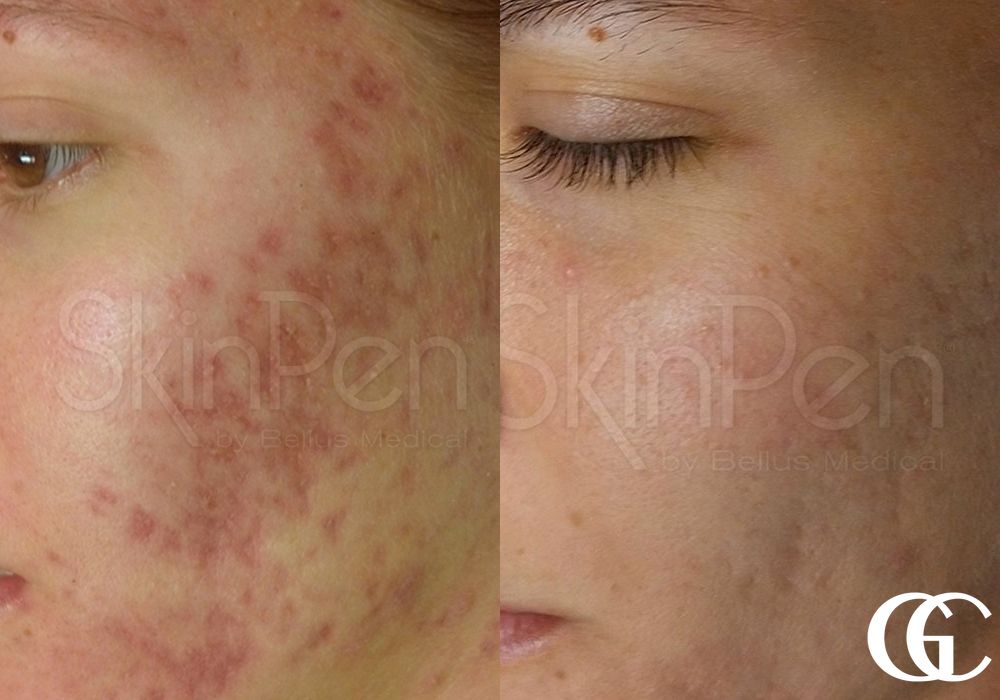 SkinPen® - Case 7462