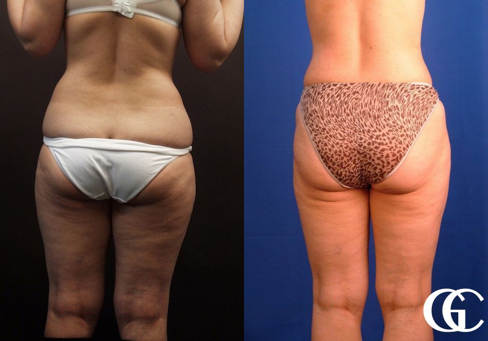 Liposuction - Thumbnail 5