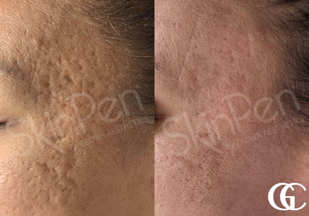 SkinPen® - Case 7465