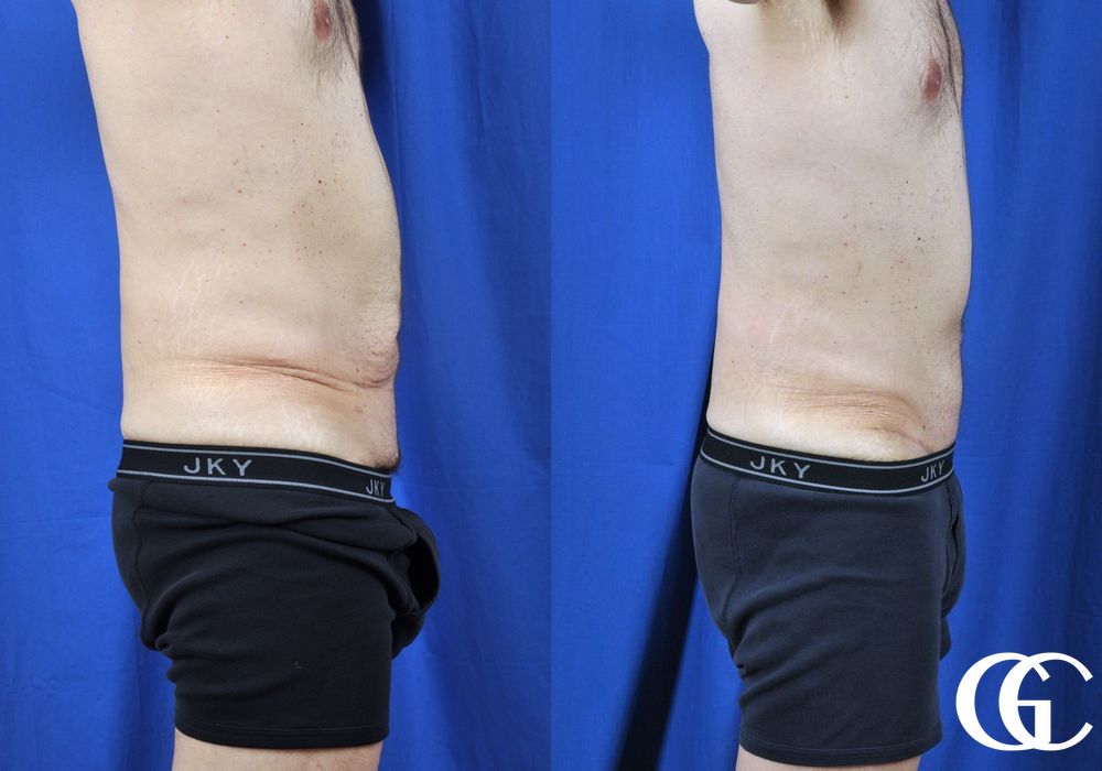 Liposuction - Thumbnail 3