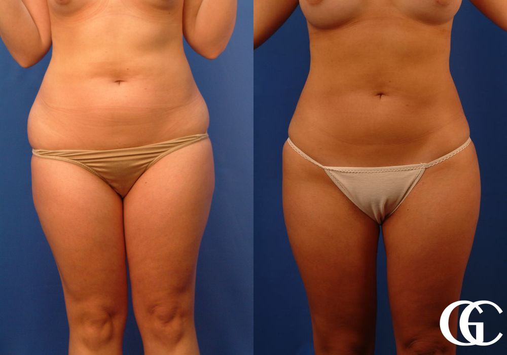 Liposuction - Case 6933