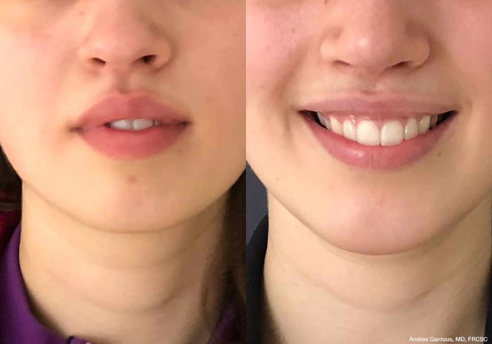 Chin Augmentation - Case 6600