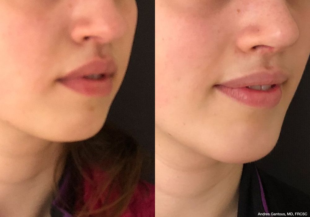Chin Augmentation - Thumbnail 2