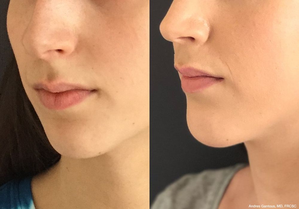Chin Augmentation - Case 6601