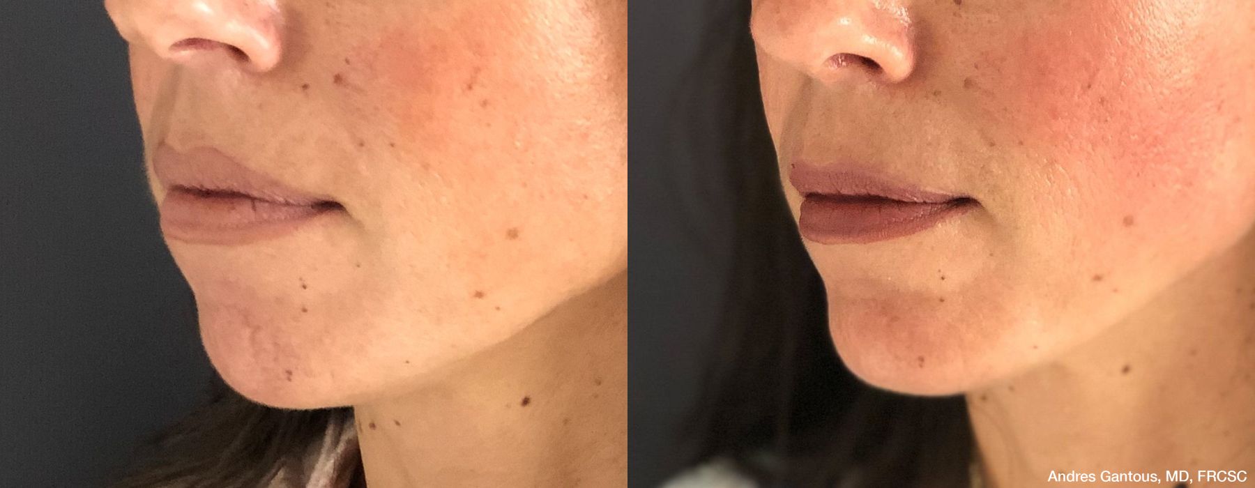 Chin Augmentation - Case 6602