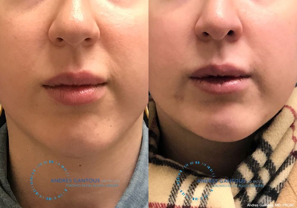 Chin Augmentation - Case 6603