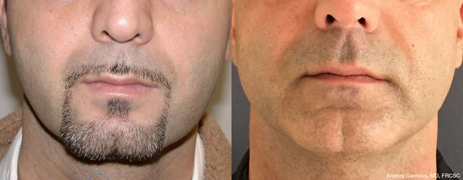 Chin Augmentation - Case 6597